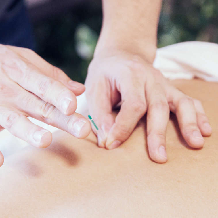 Toepassen dry needling