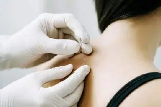 dry needling